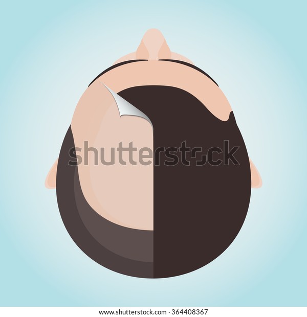 Top view portrait of a man before and after\
hair treatment and transplantation. Divided image of the head. Two\
halves. Sticker revealing healthy scalp. Isolated vector\
illustration.