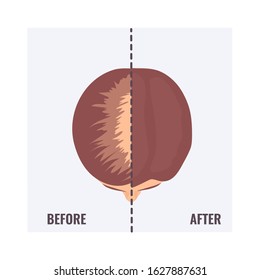 Top view portrait of a woman before and after hair treatment and  transplantation. Divided image of a female head with alopecia and restored hairline. Two halves. Beauty concept. Vector illustration.