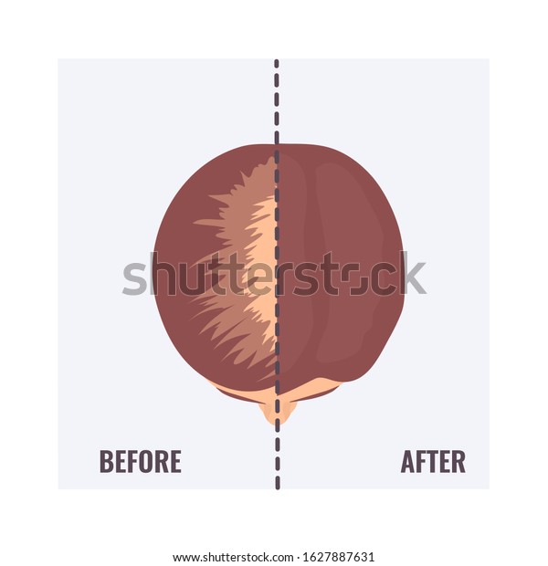 Top view portrait of a woman before and
after hair treatment and  transplantation. Divided image of a
female head with alopecia and restored hairline. Two halves. Beauty
concept. Vector
illustration.