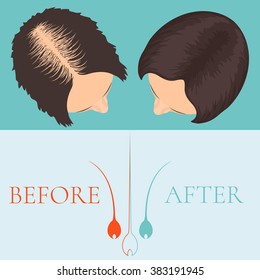 Top view of a woman before and after hair treatment and transplantation. Female alopecia. Health and beauty concept. Medical clinic concept design. Vector illustration.

