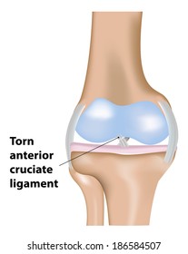 Torn ACL Ligament