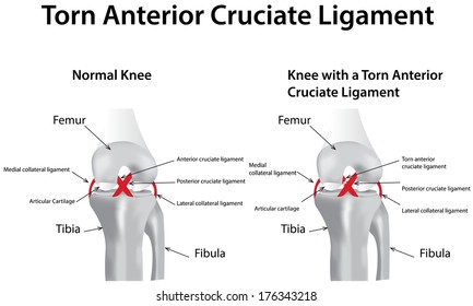 Torn Anterior Cruciate Ligament (ACL)