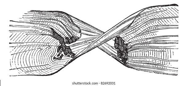 Torn Muscle Fiber, vintage engraved illustration. Trousset encyclopedia (1886 - 1891).