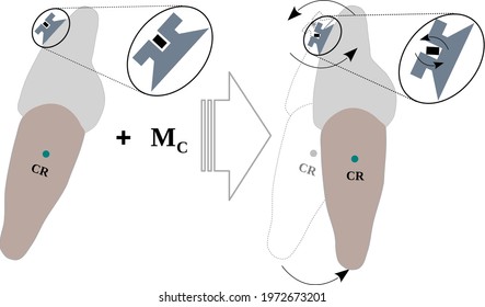 Torque experienced by a tooth due to the torque in the Bracket slot