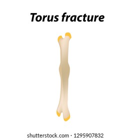 Torus fracture Bone. Infographics. Vector illustration on a lined background.