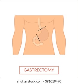 Total gastrectomy - full surgical removal of the stomach. Vector illustration for medical books.