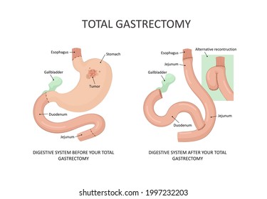 Total gastrectomy.  Stomach cancer, tumor