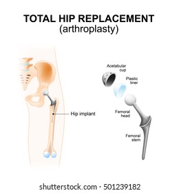 Total Hip Replacement Or Arthroplasty And Hip Implant