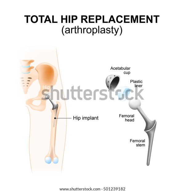 Total hip\
replacement or arthroplasty and hip\
Implant