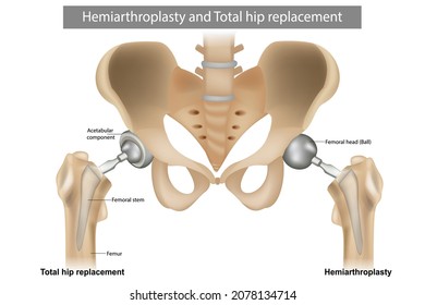 Hemiarthroplasty Images, Stock Photos & Vectors | Shutterstock