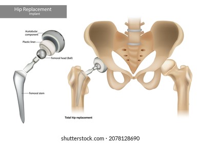 Total hip replacement components. Hip Implant.