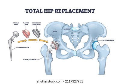 Total hip replacement surgery with anatomical acetabular prosthesis outline diagram. Labeled educational medical operation process description with new artificial bone structure vector illustration.