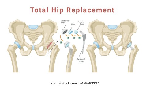 Total hip replacement surgery with anatomical acetabular prosthesis medical poster isometric vector illustration. Medicine procedure with new artificial bone structure skeleton joint education scheme