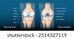 Total knee arthroplasty. Knee joint replacement. Anatomy of Normal joint and Total Knee implant. Detailed vector poster. Isometric flat illustration. Schematic diagram