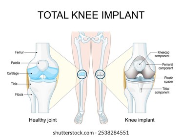 Implante total de rodilla. Primer plano de una articulación saludable de la rodilla y una articulación con implante. Afiche de Vector