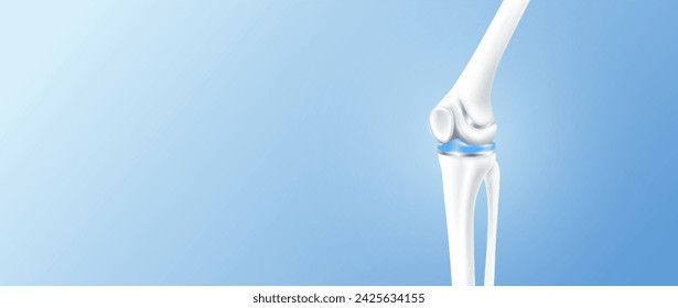 Total knee replacement or implant for treatment relieve arthritis, after joint damaged. Leg bone and cartilage side with copy space for text. Medical health care science technology concept. 3D vector.