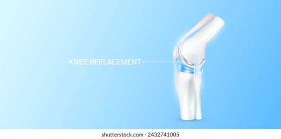 Total knee replacement or implant for treatment relieve arthritis, after joint damaged. Leg bone and cartilage ligaments side. Medical health care science technology concept. 3D vector.