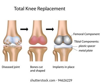 Total knee replacement surgery