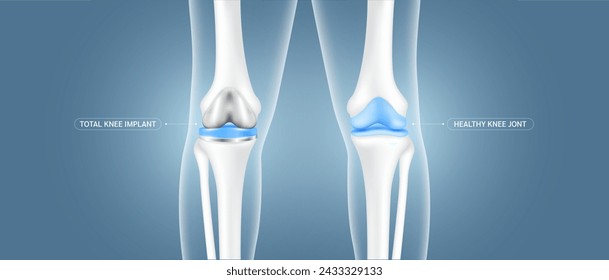 Total knee replacement surgery or implant and healthy leg bone cartilage. Treatment relieve arthritis, after joint damaged. Medical health care science technology concept. Vector EPS10.