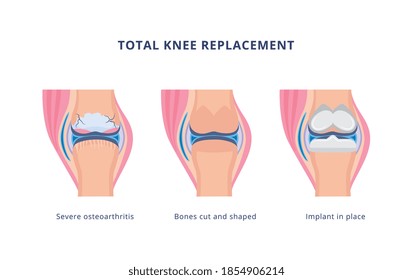 Total knee replacement surgery procedure explanation, flat vector illustration isolated on white background. Knee implant installation in case of severe osteoarthritis.