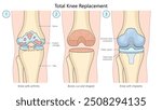 total knee replacement surgery, progression from arthritis-damaged knee to bone shaping and implant placement diagram hand drawn schematic vector illustration. Medical science educational illustration