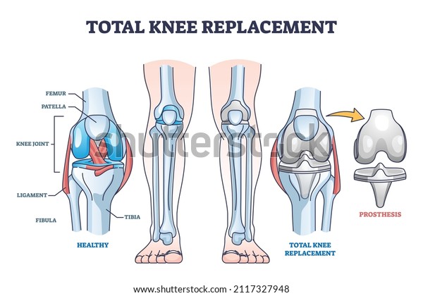 Total knee replacement surgery and\
prosthesis operation outline diagram. Labeled educational medical\
procedure description with healthy orthopedic anatomical bone\
structure scheme vector\
illustration.