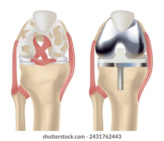 Total knee replacement. Treatment of osteoarthritis and severe limb injuries. Medical poster. Isolated vector illustration