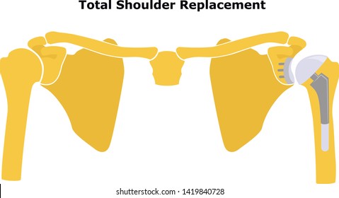Total Shoulder Replacement. Shoulder joint replacement, endoprosthetics. Osteoarthrosis of the shoulder joint. Vector illustration. Flat design.