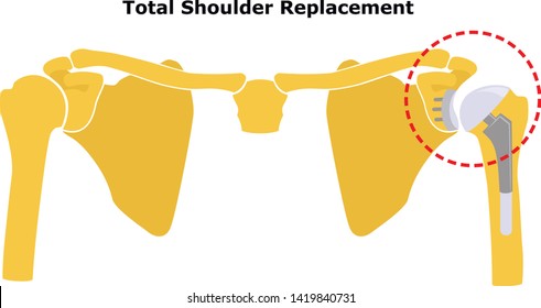 Total Shoulder Replacement. Shoulder joint replacement, endoprosthetics. Osteoarthrosis of the shoulder joint. Vector illustration. Flat design.