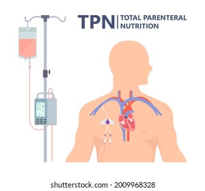 TPN PPN Total tube nutritional partial line PICC IV care unit ICU tract enteral gavage nose PEG stomach surgery system small nose large food cancer eat NG bowel PEJ pump