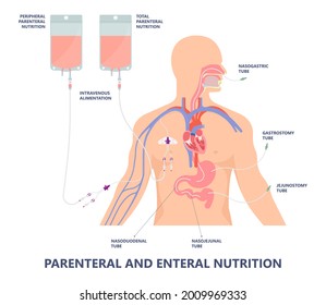 TPN PPN Total tube nutritional partial line PICC IV care unit ICU tract enteral gavage nose PEG stomach surgery system small nose large food cancer eat NG bowel PEJ pump