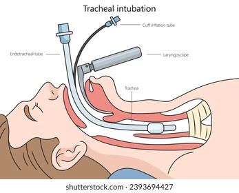 Tracheal intubation structure diagram hand drawn schematic vector illustration. Medical science educational illustration