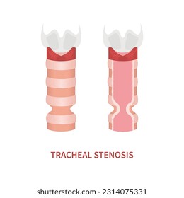 Tracheal stenosis awareness illustration. Trachea narrowing symbol. Difficulty breathing, hoarseness and voice change symptoms. Healthcare concept. Isolated flat vector illustration.