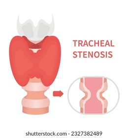 Tracheal stenosis awareness illustration. Trachea narrowing symbol. Difficulty breathing, hoarseness and voice change symptoms. Healthcare concept. Isolated flat vector illustration.