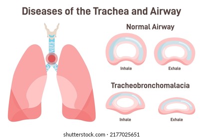 Tracheobronchomalacia. Airway and bronchial tubes disease. Soft and weak trachea close down while breathing. Flat vector illustration