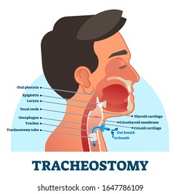 Tracheostomy cross section diagram, vector illustration labeled scheme. Intensive care unit equipment medical technology. Throat parts and tube location for breathing. Life assistance process setup.