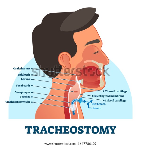 Tracheostomy cross section diagram, vector\
illustration labeled scheme. Intensive care unit equipment medical\
technology. Throat parts and tube location for breathing. Life\
assistance process\
setup.
