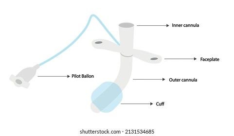 Tracheostomy device anatomy. Tracheostomy insuflated cuff.  