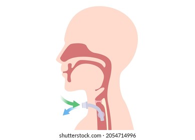 Tracheostomy at the human neck for inserted a siliconized tube into the trachea to help breathe. Illustration about surgical to help a patient who can not breathe with nose and mouth with a tube.