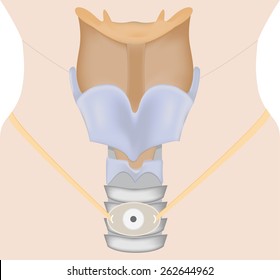 Tracheostomy Illustration