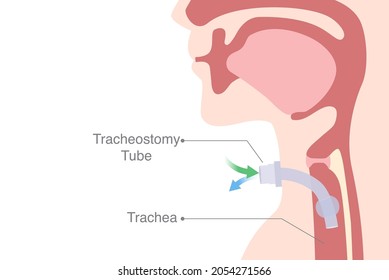 Tracheostomy is an opening created at the front of the neck for inserted a siliconized tube into the trachea to help breathe.
