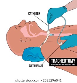 A traqueostomia é uma abertura na frente do pescoço que é feita durante um procedimento de emergência ou cirurgia planejada.