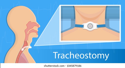 Tracheostomy Surgical Patient Treatment Procedure Medical Allergy Neck Trachea Hole Vocal Cord Paralysis Percutaneous