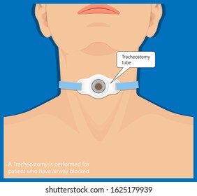 Tracheostomy Surgical Patient Treatment Procedure Medical Allergy Neck Trachea Hole Vocal Cord Paralysis Percutaneous