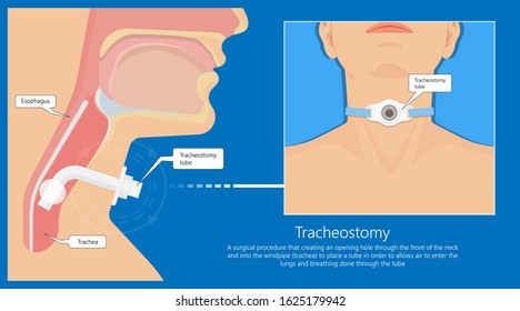 Tracheostomy Surgical Patient Treatment Procedure Medical Allergy Neck Trachea Hole Vocal Cord Paralysis Percutaneous