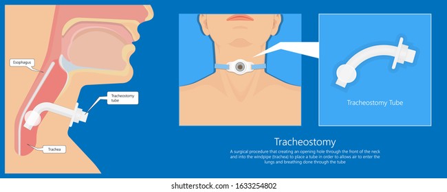 Tracheostomy Surgical Patient Treatment Procedure Medical Allergy Neck Trachea Hole Vocal Cord Paralysis Percutaneous