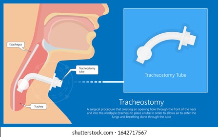 Tracheostomy Surgical Patient Treatment Procedure Medical Allergy Neck Trachea Hole Vocal Cord Paralysis Percutaneous