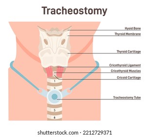 Tracheostomy. Tracheal surgery neutralise airway obstruction. Plastic cannula with inflatable cuff. Trachea anatomy. Flat vector illustration