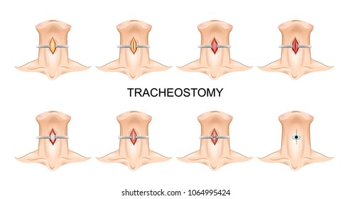 Tracheostomy Tube In-situ