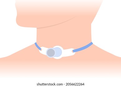 Tracheostomy tube at the patient neck who can not breathe with nose and mouth. Illustration about people has a Health Issues.